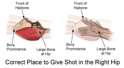 Picture of the correct place for a shot in the right hip