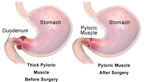 Pyloric Stenosis Causes