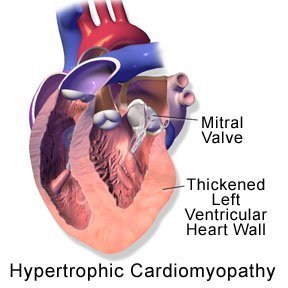 Hypertrophic Cardiomyopathy - Care Guide
