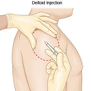 Ventrogluteal injection steroids