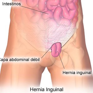 Hernia Inguinal Sintomas