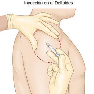 Deltoid Injection