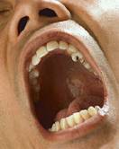 Acid Reflux From Chronic Heartburn May Damage Teeth - Drugs.com 